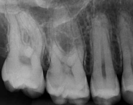 radiografica endorale