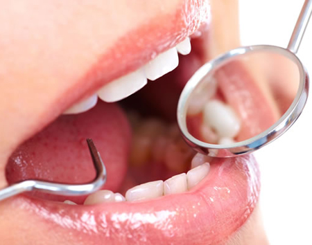otturazione dentale
