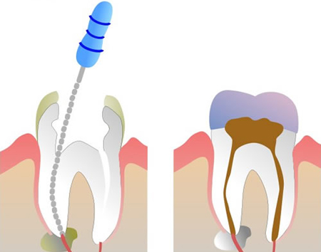 terapia canalare